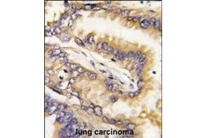 Formalin-fixed and paraffin-embedded human lung carcinoma tissue reacted with Bid BH3 Domain Antibody (ABIN388099 and ABIN2846183) , which was peroxidase-conjugated to the secondary antibody, followed by DAB staining. (BID antibody  (AA 68-103))