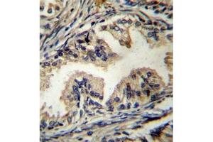 Formalin fixed, paraffin embedded human prostate carcinoma stained with STAMBP Antibody (C-term) followed by peroxidase conjugation of the secondary antibody and DAB staining. (STAMBP antibody  (C-Term))