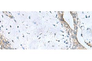 Immunohistochemistry of paraffin-embedded Human breast cancer tissue using PPIC Polyclonal Antibody at dilution of 1:50(x200) (PPIC antibody)