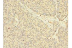 Immunohistochemistry of paraffin-embedded human ovarian cancer using ABIN7161035 at dilution of 1:100 (NANOS2 antibody  (AA 1-138))