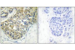 Immunohistochemical analysis of paraffin-embedded human breast carcinoma tissue using ACK1 (Phospho-Tyr284) antibody (left)or the same antibody preincubated with blocking peptide (right). (TNK2 antibody  (pTyr284))
