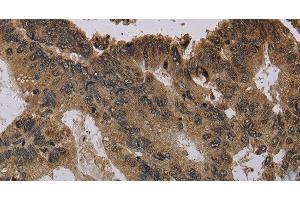 Immunohistochemistry of paraffin-embedded Human colon cancer using Histone H4 Polyclonal Antibody at dilution of 1:30 (Histone H4 antibody)