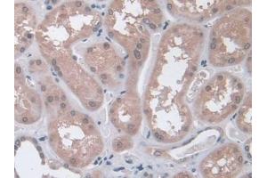DAB staining on IHC-P; Samples: Human Glioma Tissue (Interferon gamma antibody  (AA 24-166))