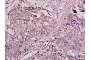 Formalin-fixed and paraffin embedded human lung carcinoma tissue labeled with Anti-MCSF Polyclonal Antibody, Unconjugated 1:400 followed by conjugation to the secondary antibody and DAB staining. (M-CSF/CSF1 antibody  (AA 201-300))