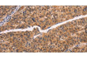 Immunohistochemistry of paraffin-embedded Human liver cancer tissue using NCAPG2 Polyclonal Antibody at dilution 1:50 (NCAPG2 antibody)
