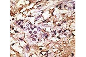 IHC analysis of FFPE human breast carcinoma tissue stained with the LC3 II antibody (LC3B antibody  (AA 77-106))
