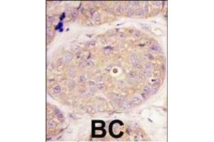 Formalin-fixed and paraffin-embedded human breast carcinoma tissue reacted with GGPS1 Antibody (C-term)((ABIN389056 and ABIN2839265)), which was peroxidase-conjugated to the secondary antibody, followed by DAB staining. (GGPS1 antibody  (C-Term))
