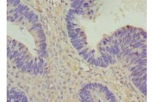 Immunohistochemistry of paraffin-embedded human ovarian cancer using ABIN7175357 at dilution of 1:100 (Vangl1 antibody  (AA 275-524))