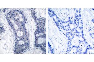 Peptide - +Immunohistochemical analysis of paraffin-embedded human breast carcinoma tissue using elF4E (Ab-209) antibody (#B7067). (EIF4E antibody  (Ser209))