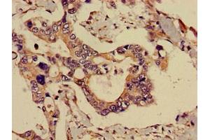 Immunohistochemistry of paraffin-embedded human pancreatic cancer using ABIN7143291 at dilution of 1:100 (ADK antibody  (AA 18-256))