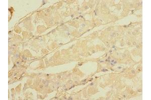 Immunohistochemistry of paraffin-embedded human gastric cancer using ABIN7146298 at dilution of 1:100 (CALHM3 antibody  (AA 201-350))