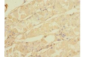Immunohistochemistry of paraffin-embedded human gastric cancer using ABIN7146298 at dilution of 1:100