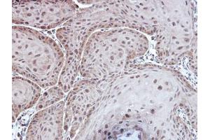 IHC-P Image Immunohistochemical analysis of paraffin-embedded Cal27 xenograft, using Aspartoacylase, antibody at 1:100 dilution.