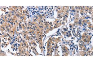 Immunohistochemistry of paraffin-embedded Human lung cancer tissue using INTS10 Polyclonal Antibody at dilution 1:50 (INTS10 antibody)
