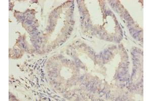 Immunohistochemistry of paraffin-embedded human endometrial cancer using ABIN7174707 at dilution of 1:100 (RPAP2 antibody  (AA 1-154))