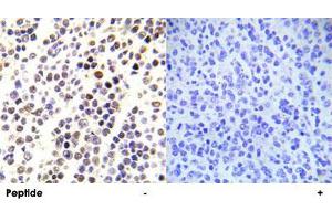 Immunohistochemical analysis of paraffin-embedded human malignant lymphoma tissue using HIST1H3E (phospho S28) polyclonal antibody . (HIST1H3E antibody  (pSer28))