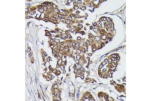 Immunohistochemistry of paraffin-embedded human breast cancer using FERMT2 Rabbit pAb (ABIN6131926, ABIN6140582, ABIN6140583 and ABIN6224757) at dilution of 1:300 (40x lens). (FERMT2 antibody  (AA 380-550))