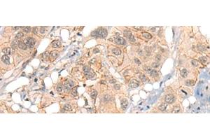 Immunohistochemistry of paraffin-embedded Human esophagus cancer tissue using GPR55 Polyclonal Antibody at dilution of 1:40(x200)