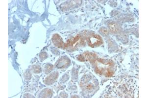 Formalin-fixed, paraffin-embedded human Breast Carcinoma stained with Major Vault Protein Rabbit Recombinant Monoclonal Antibody (VP2897R). (Recombinant MVP antibody)
