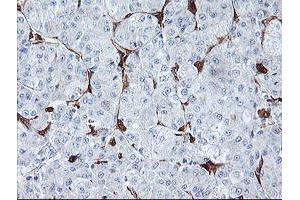 Immunohistochemical staining of paraffin-embedded Carcinoma of Human liver tissue using anti-BCAT1 mouse monoclonal antibody.
