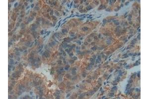 Detection of PDGF BB in Human Thyroid cancer Tissue using Polyclonal Antibody to Platelet Derived Growth Factor BB (PDGF BB) (PDGF-BB Homodimer (AA 82-190) antibody)