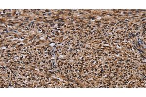 Immunohistochemistry of paraffin-embedded Human sarcoma using KIF1C Polyclonal Antibody at dilution of 1:60 (KIF1C antibody)