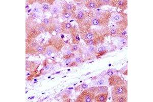 Immunohistochemical analysis of Anamorsin staining in human liver cancer formalin fixed paraffin embedded tissue section. (CIAPIN1 antibody)