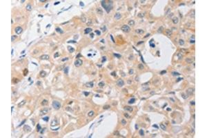 The image on the left is immunohistochemistry of paraffin-embedded Human lung cancer tissue using ABIN7191756(P2RY11 Antibody) at dilution 1/40, on the right is treated with synthetic peptide. (P2RY11 antibody)