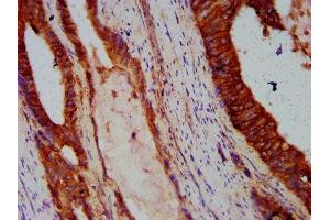 IHC image of ABIN7146195 diluted at 1:300 and staining in paraffin-embedded human colon cancer performed on a Leica BondTM system.