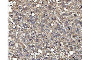 IHC analysis of ME1 using anti-ME1 antibody (ABIN7599485). (ME1 antibody  (AA 1-572))