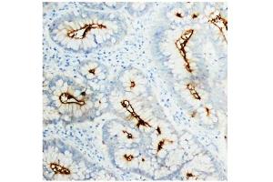 Immunohistochemistry (IHC) image for anti-Carcinoembryonic Antigen-Related Cell Adhesion Molecule 5 (CEACAM5) antibody (ABIN1106531) (CEACAM5 antibody)