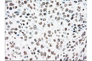 Immunohistochemical staining of paraffin-embedded Adenocarcinoma of colon tissue using anti-PLK1mouse monoclonal antibody. (PLK1 antibody)