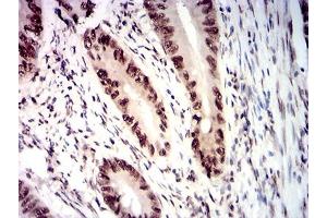 Immunohistochemical analysis of paraffin-embedded rectum cancer tissues using RBBP7 mouse mAb with DAB staining. (RBBP7 antibody  (AA 1-200))