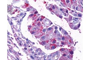 Anti-OPN5 antibody IHC of human Ovary, Carcinoma. (OPN5 antibody  (C-Term))