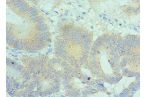 Immunohistochemistry of paraffin-embedded human colon cancer using ABIN7169161 at dilution of 1:100 (PLK2 antibody  (AA 336-685))
