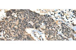Immunohistochemistry of paraffin-embedded Human lung cancer tissue using CCNB1IP1 Polyclonal Antibody at dilution of 1:30(x200) (CCNB1IP1 antibody)