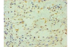 Immunohistochemistry of paraffin-embedded human breast cancer using ABIN7163201 at dilution of 1:100 (PIP4K2B antibody  (AA 1-270))