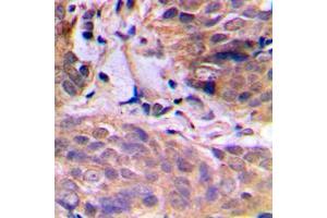 Immunohistochemical analysis of HuB staining in human breast cancer formalin fixed paraffin embedded tissue section. (HuB (Center) antibody)