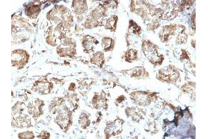 Formalin-fixed, paraffin-embedded human Breast Carcinoma stained with NME2 / nm23-H2 Mouse Monoclonal Antibody (CPTC-NME2-2). (NME2 antibody)
