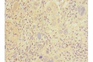 Immunohistochemistry of paraffin-embedded human liver cancer using ABIN7146045 at dilution of 1:100 (C-Type Lectin Domain Family 1, Member B (CLEC1B) (AA 55-229) antibody)
