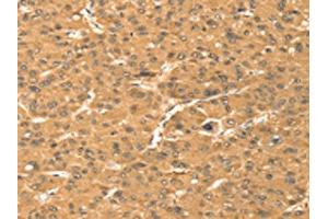 The image on the left is immunohistochemistry of paraffin-embedded Human liver cancer tissue using ABIN7131392(TMEM123 Antibody) at dilution 1/25, on the right is treated with fusion protein. (TMEM123 antibody)