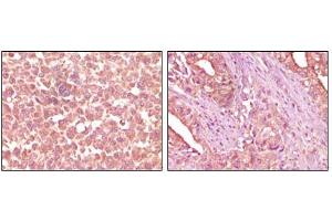 Immunohistochemical analysis of paraffin-embedded human skin carcinoma (left) and pancreas carcinoma (right) tissue, showing cytoplasmic localization using EphA2 mouse mAb with DAB staining. (EPH Receptor A2 antibody)