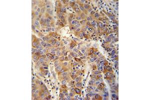 VP4 antibody (Center) (ABIN652042 and ABIN2840516) immunohistochemistry analysis in formalin fixed and paraffin embedded human hepatocarcinoma followed by peroxidase conjugation of the secondary antibody and DAB staining. (VAMP4 antibody  (AA 16-45))