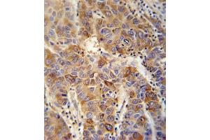 VP4 antibody (Center) (ABIN652042 and ABIN2840516) immunohistochemistry analysis in formalin fixed and paraffin embedded human hepatocarcinoma followed by peroxidase conjugation of the secondary antibody and DAB staining.