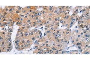 Immunohistochemistry of paraffin-embedded Human liver cancer using ATXN1 Polyclonal Antibody at dilution of 1:40 (Ataxin 1 antibody)