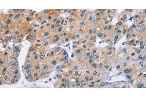 Immunohistochemistry of paraffin-embedded Human liver cancer using ATXN1 Polyclonal Antibody at dilution of 1:40 (Ataxin 1 antibody)
