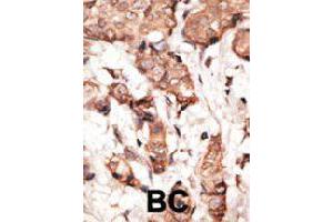 Formalin-fixed and paraffin-embedded human cancer tissue reacted with STAT2 polyclonal antibody  , which was peroxidase-conjugated to the secondary antibody, followed by DAB staining. (STAT2 antibody  (C-Term))