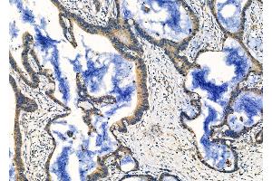 ABIN6260218 and ABIN6276684 at 1/100 staining Human colorectal cancer by IHC-P. (Butyrylcholinesterase antibody  (C-Term))