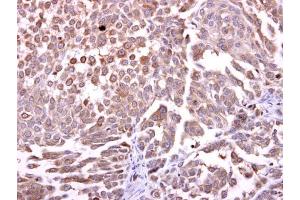 IHC-P Image CCKBR antibody [C1C2], Internal detects CCKBR protein at cytosol on human lung carcinoma by immunohistochemical analysis.