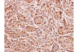 IHC-P Image Immunohistochemical analysis of paraffin-embedded A549 xenograft, using NAT2, antibody at 1:100 dilution.